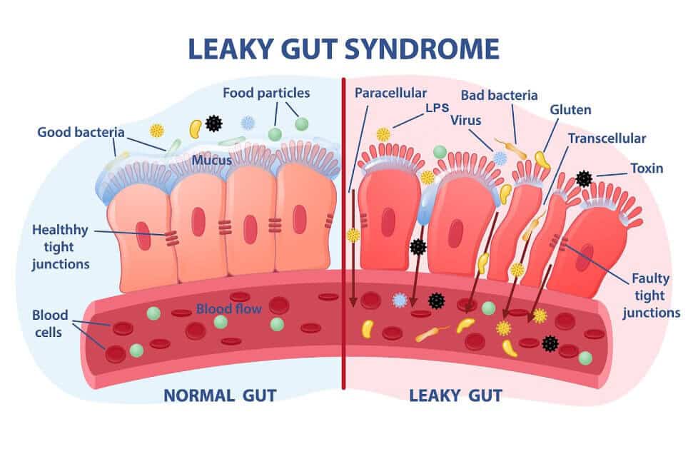 leaky gut